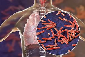 Ngăn chặn hiểm họa kép đồng nhiễm HIV/lao