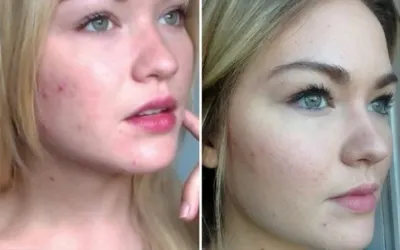 Gợi ý cách trị mụn bọc chuẩn y khoa hiệu quả tại nhà, ngăn ngừa sẹo xấu